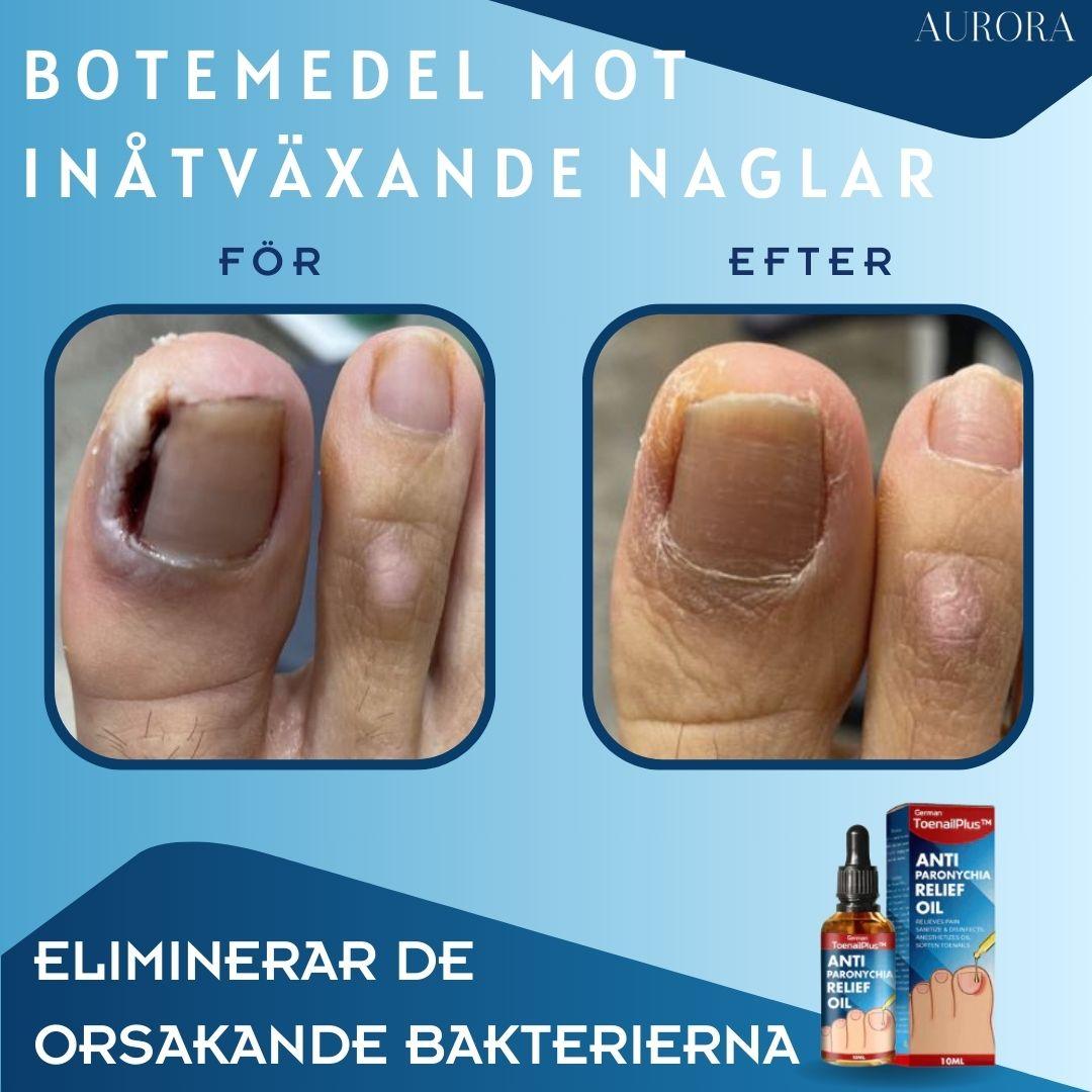 ToePerfect⹠- LÀker tÄnaglar och handnaglar | 1+1 FREE TEMPORARY - Aurora Stockholm