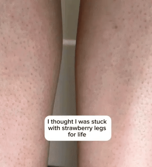 1 + 1 GRATIS IDAG DermaBare™