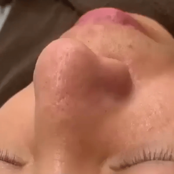 TILLFĂLLIGT 50% OFF DermaVeoâą