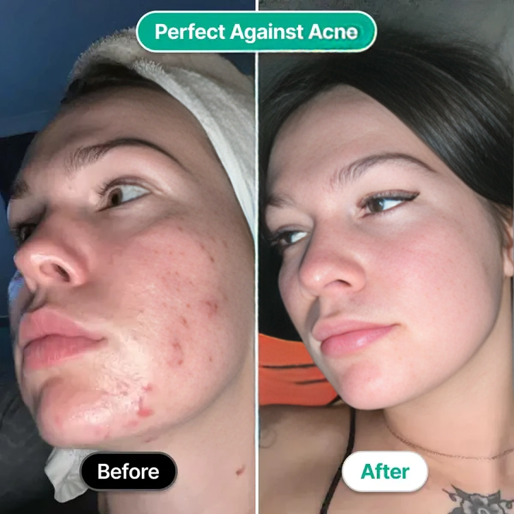TILLFĂLLIGT 50% RABATT | AcneZapâą | Högfrekvent ansiktsstav