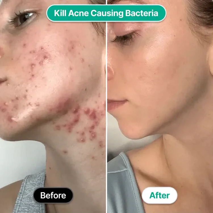 TILLFĂLLIGT 50% RABATT | AcneZapâą | Högfrekvent ansiktsstav