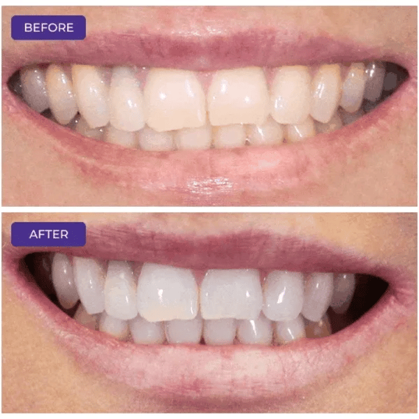 1 + 1 GRATIS IDAG  LumaSmile™