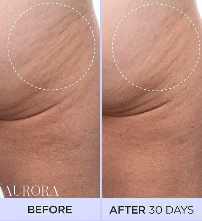 1 + 1 GRATIS IDAG | SmoothSculpt™ | Säg hej till en synbart fastare hud!