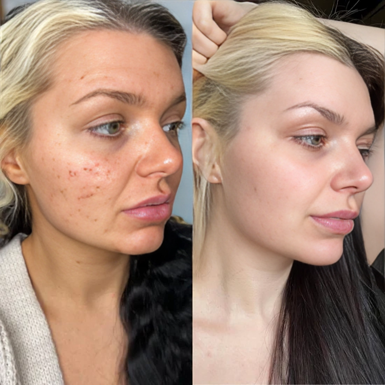 TILLFÄLLIGT 50% RABATT | GlowLift™ | Hemligheten bakom tidlös skönhet!