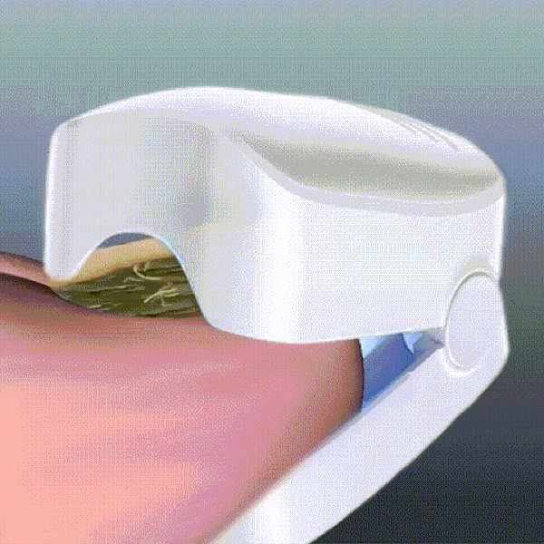 TILLFÄLLIGT 50% OFF  NailCure™